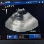 Ultrazvuk nás potěšil